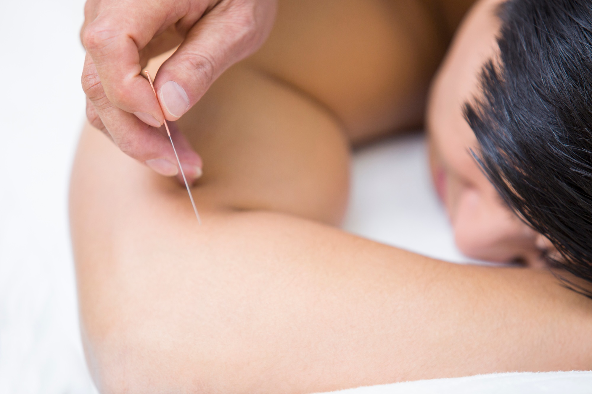 Patient receiving acupuncture